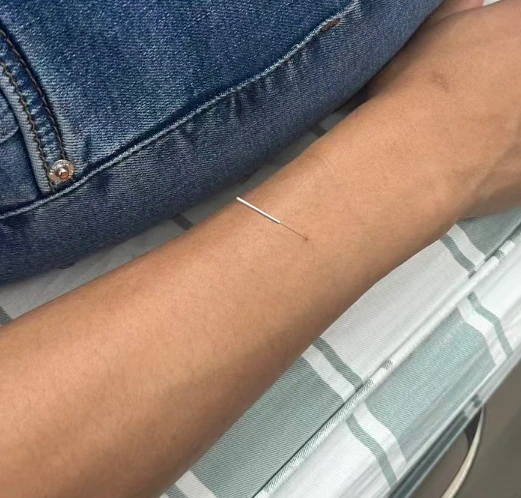 On-site photograph of acupuncture on the arm