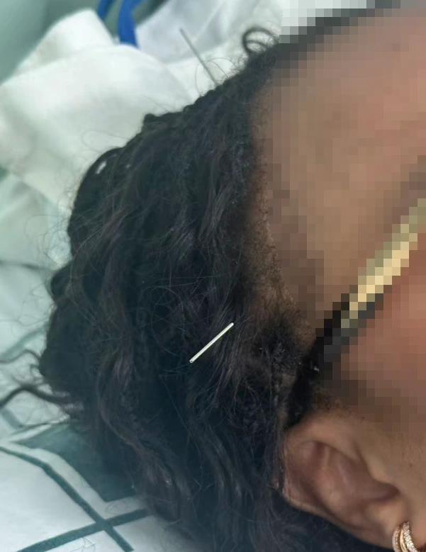 Acupuncture needle visible in the hair, with the facial area lightly obscured